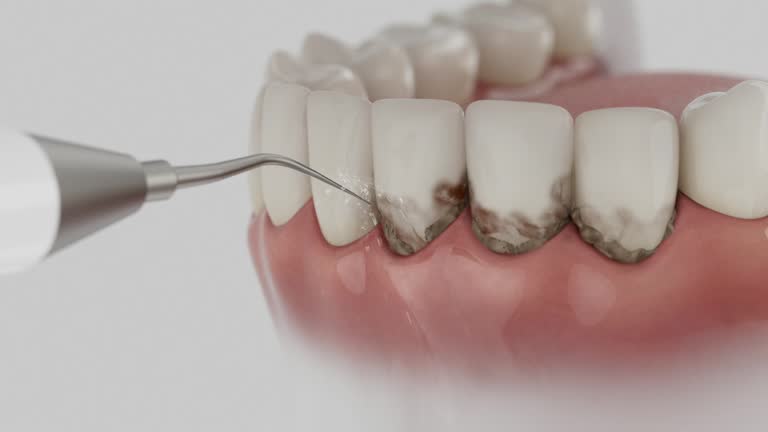 Trusted Wisdom Tooth Removal service in Glasgow, VA - Dentist Open Now